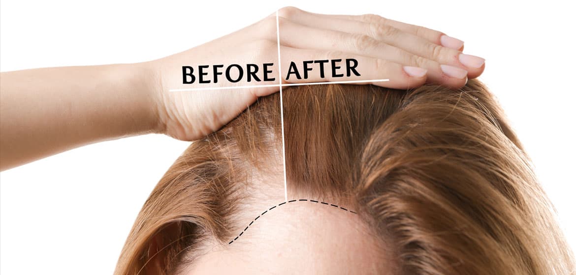 Female hair transplant