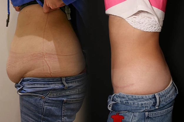 Tummy Tuck